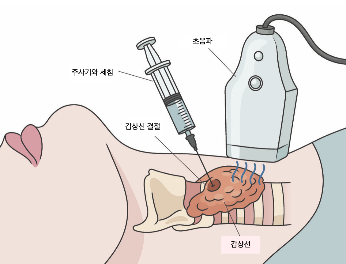 암검진